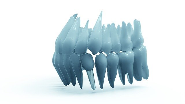 teeth-2833417_640